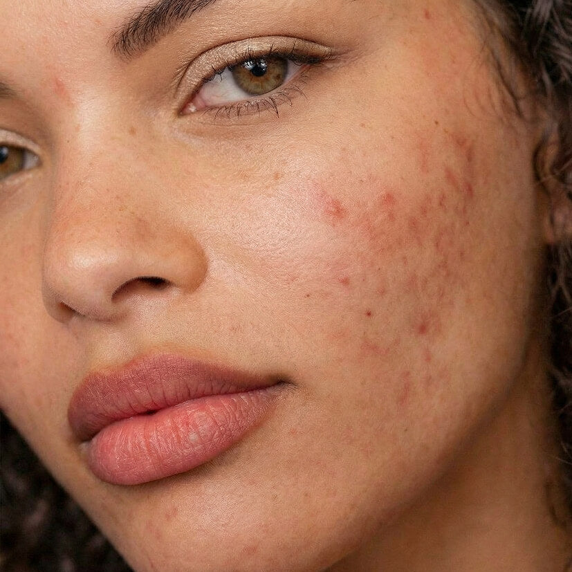 Before skin with acne and blemishes